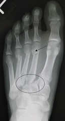Lisfranc Fx (Metatarsal displaced from Tarsus - rarely heals fully)