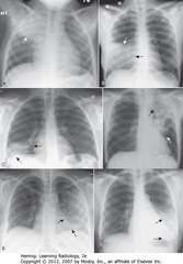 LOBAR PNA
• A:RUL - sharp margin PNA obscures (silhouettes) ascending aorta (RA)
• B: RML - disease silhouettes R heart border (BA)
• C: disease silhouettes right Hd (BA)
• C: R heart border (DBA)
• D: LUL - dz poorly marginated (WA)
• D: obscured aortic knob (BA)
• E : dz silhouettes L heart border (SBA)
• E: L Hd (DBA)
• F: disease obscures L Hd (DBA)
• F: L heart border (SBA)