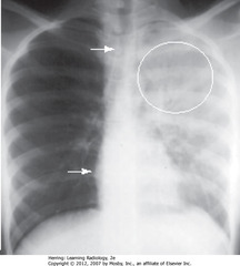 LUL PNA 
• No heart shift, some trachea shift (WA)
• Air bronchograms w/in upper area of opacification (WC)
• Suggestive of PNA rather than atelectasis or pleural effusion
• Dx: S. pneumoniae of LUL