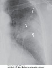 LUL PNA
• Air bronchograms - seen centrally in airspace disease (SWA)
• Homogeneous density except air bronchograms
• Outer edges fluffy, poorly marginated (characteristic of airspace disease) (DWA)