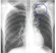 LUL Tuberculosis: Calvitary Lesion