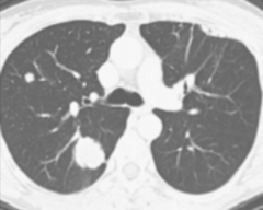 Lung Cancer CT