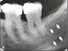 mandibular canal

(inferior alveolar canal)