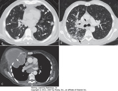 METS TO LUNG, CT scans. 
• A-WA: - multiple discrete nodules, varying size, throughout both lungs
• Dx of exclusion when multiple nodules in lung is metastatic dz
• B-WA: prominent interstitial markings
• B-DBA: septal lines
• B-SBA: lymphadenopathy from lymphangitic spread bronchogenic carcinoma
• C-WA: lung CA grown through chest wall, invaded by direct extension
• Pleura usually strong barrier to direct tumor spread