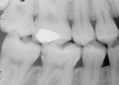 moderate caries on distal 30