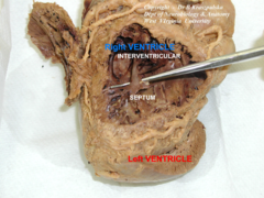 moderator band of right ventricle