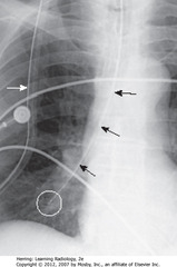 NGT IN RLL BRONCHUS
• MC malpositioned of all tubes/lines - usually coiling in esophagus
• SBA: NG tube - entered trachea instead of esophagus
• WC: tip in RLL
• SWA: part of NG tube outside patient is superimposed on chest (so are heart monitor leads)
