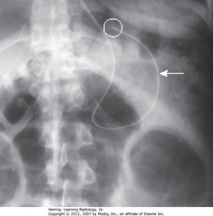 NGT IN STOMACH
• SWA: tip of NG tube - radiopaque stripe, 