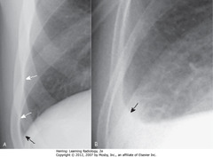 NML & BLUNTED R LATERAL COSTOPHRENIC ANGLE
• A - SBA: lateral costophrenic angle created when Hd makes sharp, acute angle as it meets lateral chest wall on frontal
• A - SWA: normally aerated lung extends to inner margin of each rib
• B - SBA: lateral costophrenic sulcus loses acute angulation, becomes blunted when effusion reaches 300 mL volume