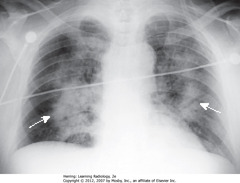 NONCARDIOGENIC PULMONARY EDEMA
• SWA: Perihilar distribution of airspace disease similar to cardiogenic pulmonary edema 
• No pleural fluid, fluid in fissures or cardiomegaly
• Noncardiogenic pulmonary edema less likely to have pleural effusions and Kerley B lines, more likely to have a normal pulmonary capillary wedge pressure (PCWP) of < 12 mm Hg, and more likely to be associated w/normal-sized heart than cardiogenic pulmonary edema