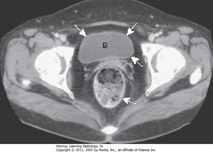 NORMAL BLADDER
• Urinary bladder (B) with unopacified urine in early image of contrast-enhanced pelvic CT 
• SWAs: bladder wall - thin, of equal thickness around the circumference of bladder
• DWA: rectum - posterior to bladder