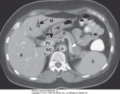 NORMAL LIVER
• DBA: ligamentum teres - divides left lobe of liver into medial (M) and lateral segment (L) with larger right lobe (R) lying more posterior
• Portal vein (PV) lies just posterior to hepatic artery
• SWA: splenic artery - follows pancreas (P) toward spleen (S)
• Inferior vena cava (IVC) lies to right of aorta (A)