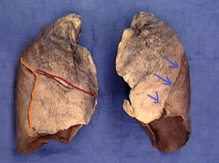 oblique fissure of left lung