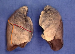 oblique fissure of the right lung = orange line

horizontal fissure of the right lung = red line