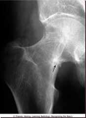 Osteomalacia (Vitamin D deficiency and malnutrition in Adults = older version of Rickets, after epiphyseal closure has occurred)