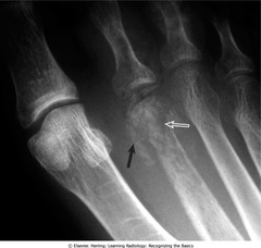 Osteomyelitis (of 2nd MT, infection and inflammation)