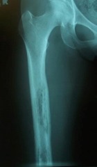 Osteomyelitis (of Femur, infection and inflammation)
