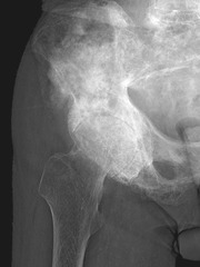 Pagets Disease (localized, pelvic area)