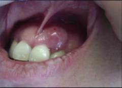Periapical Abscess (Chronic, Asymptomatic)
