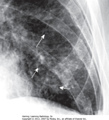 PERIBRONCHIAL CUFFING
• Bronchus normally invisible when seen on-end in lung periphery 
• SWA: bronchial walls, thickened, ringlike densities when seen on-end, caused by fluid accumulation in interstitial tissue around and in wall of a bronchus
• Seen in CHF
• May not always produce perfectly round circles