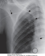 PICC IN RA
• SBA: PICC line
• Tip should lie within SVC, but may be placed in axillary vein
• BC: tip extends to RA