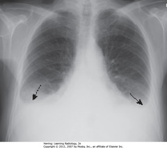 PLEURAL EFFUSIONS IN CHF
• BAs: bilateral pleural effusions
• Usually bilateral in CHF, may be symmetric, w/right side slightly larger
• Unilateral, L pleural effusion can happen in CHF, but should suspect another cause - ex. metastatic disease