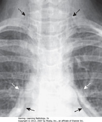 PNEUMOMEDIASTINUM, PNEUMOPERICARDIUM, SUBCUTANEOUS EMPHYSEMA 
• SWA: streaky white densities extending to neck - produced by air from pneumomediastinum tracking back to hila, then into mediastinum
• DBA: SQ emphysema in neck
• SBA: pneumopericardium - unusual in adults - air usually only enters pericardium by direct penetration
• Air in pericardial space isn't extending above reflections of aorta and pulmonary artery
• Pneumomediastinum does extend above great vessels, normally
