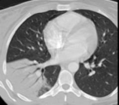 Pneumonia CT