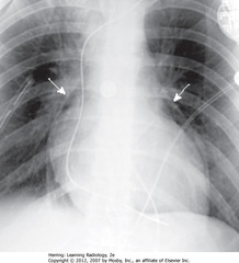 PNEUMOPERICARDIUM
• SWA: visible parietal percardium outlining air around heart in pericardial space - indicates pneumopericardium
• Air does not extend above reflection of aorta and main pulmonary artery
• Pneumopericardium in adults usually from trauma
