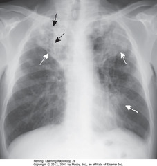 POST-PRIMARY TB (reactivation tuberculosis)
• SWA: cavitary PNA ULs
• SBA: Lucencies (cavities) throughout airspace dz in RUL
• Cavitary UL PNA presumed TB until proven otherwise
• DWA: Airspace disease in lingula