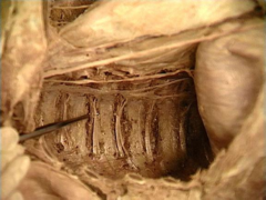 posterior intercostal vein, artery and nerve (VAN) mnemonic