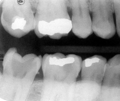 primary occlusal decay on 30, 31