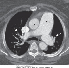 PULMONARY ARTERIAL HTN
• MPA - main pulmonary artery - usually same diameter as ascending aorta (A)
• This pt has pulmonary artery HTN, so MPA is larger than aorta
• SWA: pruning - rapid attenuation in size of pulmonary arteries seen in pulmonary arterial HTN