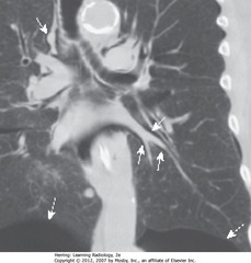 PULMONARY INTERSTITIAL EMPHYSEMA
• SWA: air surrounding pulmonary arteries
• Air from ruptured alveolus in asthma pt; tracked back to hilum, produced pneumomediastinum and SQ emphysema
• DWA: bilateral, basilar PTXs