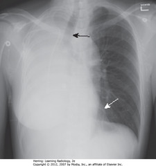 R LUNG ATELECTASIS
• Complete R Ht opacification
• SBA: trachea shifted toward atelectasis
• SWA: LH border displaced to right, almost overlaps spine
• Dx: endobronchial metastasis in R main bronchus from L-sided breast CA