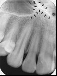 radiograph inverted Y-line

(made by the nasal fossa and maxillary sinus)