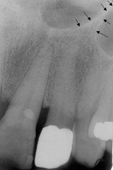 radiopaque inverted Y present in the lateral canine area-important for people with no teeth lookin for new teefff
