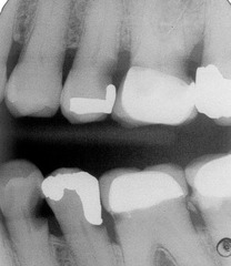 recurrent secondary caries