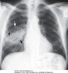 RLL PNA
• BA: increased opacification in right midlung field
• WA: indistinct margins, characteristic of airspace disease
• DBA: minor fissure bisects disease - PNA in superior segment of RLL
• RH border, R Hd visible (disease not in contact)