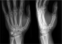 Rolando Fracture (Comminuted Bennetts)
