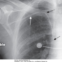 SC CVL - CORRECT POSITION
• SWA: CVL - 3 mm - uniformly opaque, no marker stripe
• DBA: medial end of clavicle - CVL should reach here before descending
• SBA: SVC - catheter should descend to right of thoracic spine, with tip in SVC