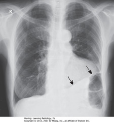 SCARRING PRODUCING BLUNTING OF L COSTOPHRENIC ANGLE
• SBA: 