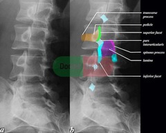 Scotty Dog (Anterior Oblique view of Lumbar spine best for viewing Pars Interarticularis Fx aka Spondylolysis)