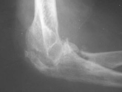 Septic Arthritis (of the Elbow)