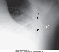 SIDE HOLE OF CHEST TUBE OUTSIDE THORAX
• SWA: side holes outside thoracic wall
• SBA: tube kinked as entering chest
• Underlying pleural effusion
• Air leak makes pleural effusion persist
