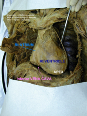 sternocostal surface of the heart