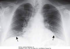 SUB-OPTIMAL INSPIRATION
• 8 posterior ribs visible
• Black arrows: crowded - accentuates lung markings at bases
• Crowded lung markings mimic aspiration or PNA
• Get lateral CXR to determine if basilar airspace disease actually present