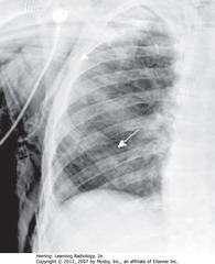 SUBCUTANEOUS EMPHYSEMA
• SWA: air dissecting along muscle bundles looks comblike, striated