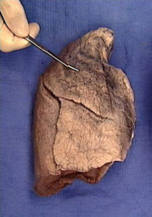 superior lobe of right lung