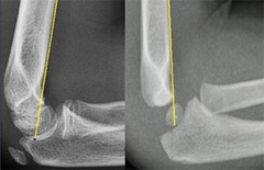 Supracondylar Fx (usually distal Humerus just above the Epicondyles in a child)